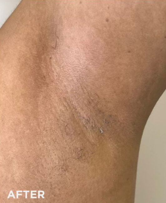 Chemical Peel, Vi peel New York City Manhattan